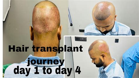 My Hair Transplant Experience Hair Transplant Journey Best Hair Transplant Technique Hair