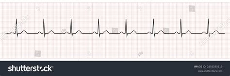 Ekg Showing Normal Sinus Rhythm Of Patient Royalty Free Stock Vector