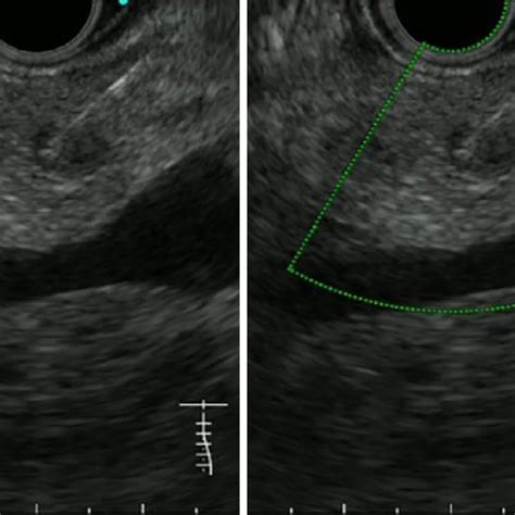 Figure5 Endoscopic Ultrasound Guided Fine Needle Aspiration A 22 Gauge Download Scientific