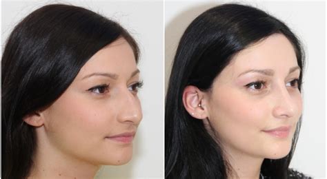 Rhinoplasty Surgery In Sydney Nsw Dr Miroshnik