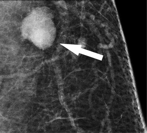 Axillary Nodal Evaluation In Breast Cancer State Of The Art Radiology