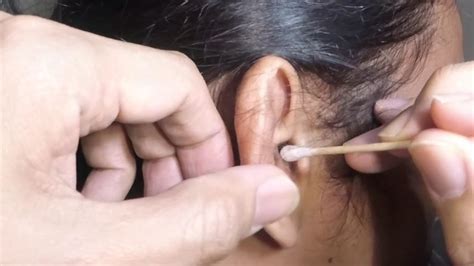 Man S Dry Earwax Removal Using Cotton Pledget Youtube