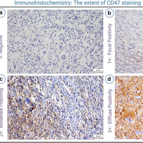 Immunohistochemistry IHC Of CD47 Expression In Human Soft Tissue