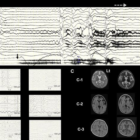 EEG And Brain Imaging Of Subjects A Ictal EEG Before LTACTH In Case