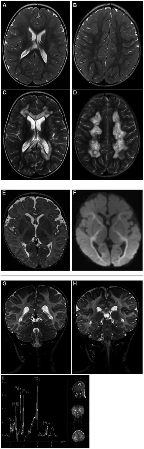 Brain Mri Studies In Nfu1 Mutant Patients 2 T2 Weighted Axial Scans At