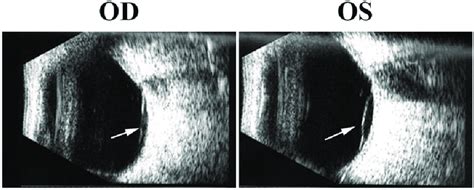 B Scan Ultrasonography Of Both Eyes 1 Week After The Onset Of Ocular