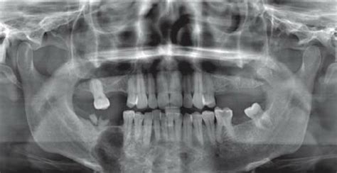 Orthopantomograph Shows Mixed Radiopaque And Radiolucent Lesion In