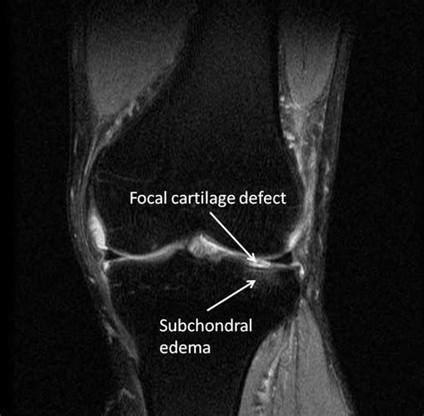 Mri Knee Cartilage Damage