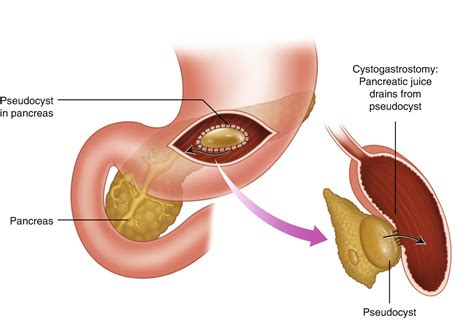 Pancreatic Pseudocyst Drainage