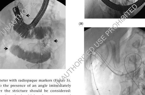 Contrast Injection Downstream Of A Malignant Duodenal Stricture Download Scientific Diagram