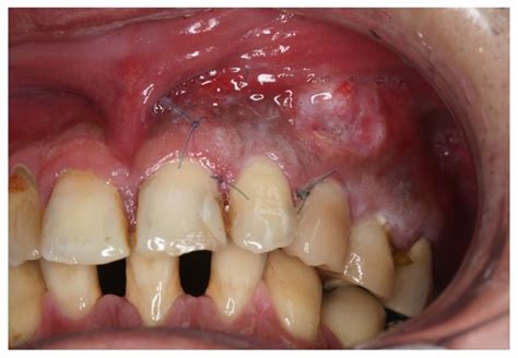 Primary Intraosseous Squamous Cell Carcinoma Derived From A Maxillary