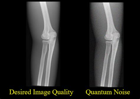 Physics General Xray Concepts Flashcards Quizlet