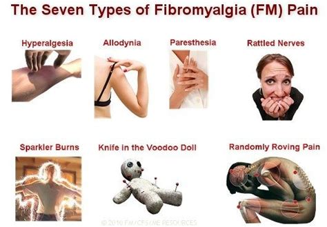 7 Types Of Fibromyalgia Pain Pain D Epices Fibromyalgia Pain And Fibromyalgia