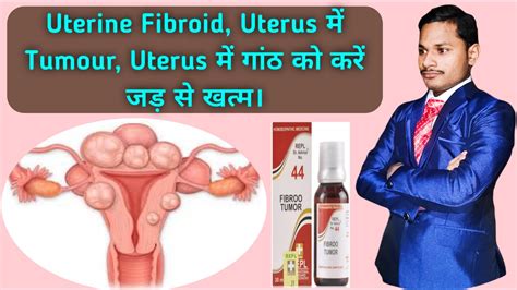 Uterine Fibroid Ka Homeopathic Ilaj Uterus Me TumourWithout Surgery