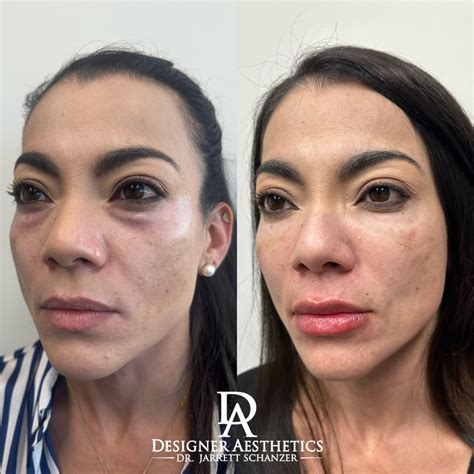 Facial balancing / full face rejuvenation miami aesthetics injections
