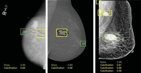 Examples Of Breast Lesions Detection And Classification Results And