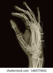 X Ray Fracture Hand Bones Stock Photo 1483774031 | Shutterstock