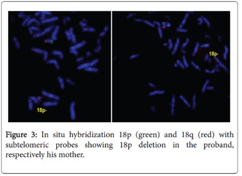 Genetic Counselling In A Familial Deletion 18p Syndrome Omics International