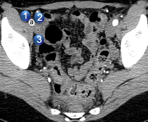 Lymphatic Metastases From Pelvic Tumors Anatomic Classification Characterization And Staging