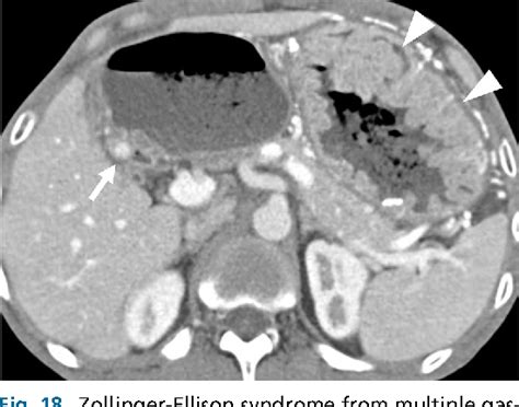 Table 1 From Imaging And Screening Of Hereditary Cancer Syndromes