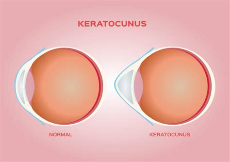 Keratoconus Treatment Options First Eye Care Dfw Optometry