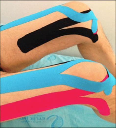 Kinesio Tape application to vastus medialis, vastus lateralis, and ...