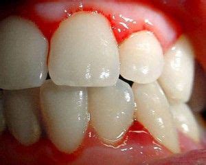 Swollen Gum Around One Tooth Causes And Treatment Artofit