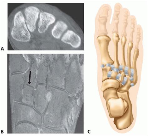 Open Reduction And Internal Fixation Of Lisfranc Injury Musculoskeletal Key