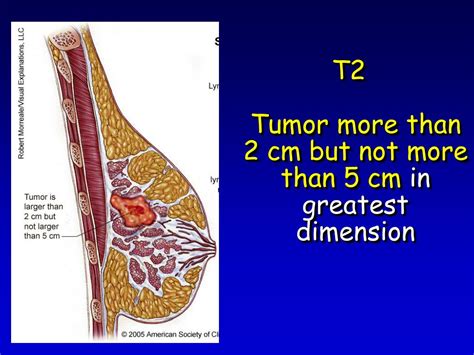 Ppt Tnm Staging And Prognosis Powerpoint Presentation Free Download