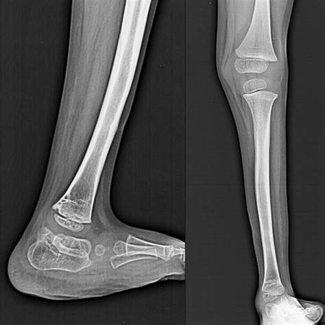 Fibular Hemimelia Treatment, Symptoms, & Causes - Trishla Foundation