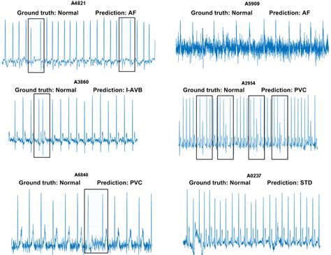 Abnormal Ecg Examples