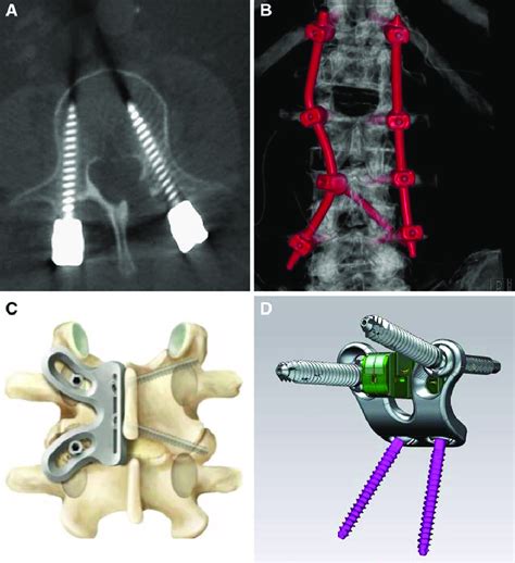 A The Combination Of A More Straightforward Cortical Bone Trajectory