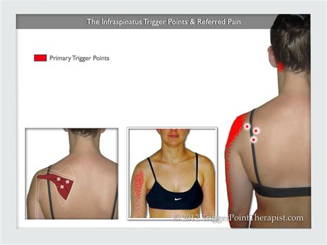 Infraspinatus Trigger Points The Magicians Of Shoulder Pain