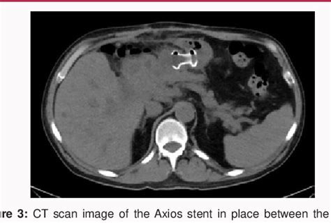 Figure 1 From Endoscopic Ultrasound Guided Gastrojejunostomy Stent