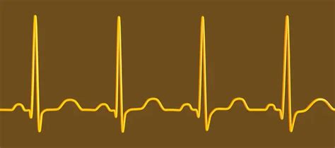 Illustration Electrocardiogram Ecg Showing Sinus Tachycardia Common