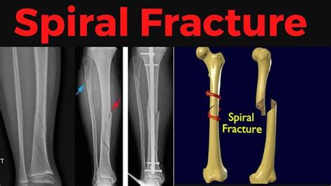 Spiral Fracture Medizzy