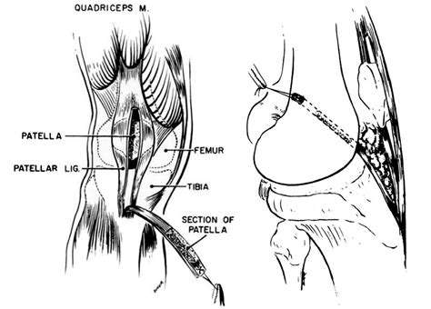 Left The Middle One Third Of The Patellar Tendon Is Detached