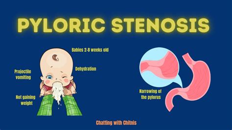 Pyloric Stenosis Youtube