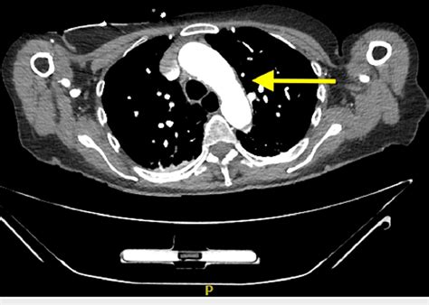 An axial, contrast-enhanced CT image of the thoracic aorta revealed no ...