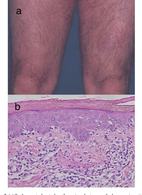 Figure From Anaplastic Large Cell Lymphoma Associated With