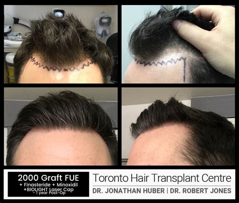 Hair Transplant Results Toronto Hair Transplant Surgeons