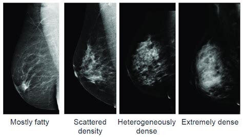 American College Of Radiology Breast Imaging Reporting And Data System