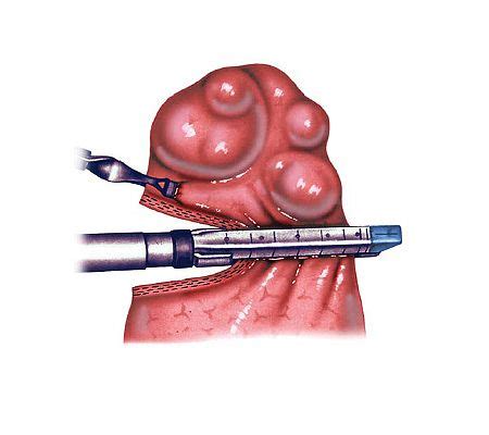 Biopsie Pulmonaire Thoracoscopie Chirurgie Thoracique Hopital Bichat