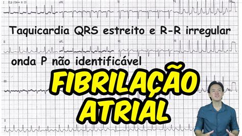 Eletrocardiograma Analise Fibrilacao Atrial Youtube Otosection