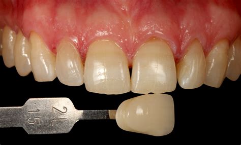 Overcoming challenges in teeth whitening: tetracycline staining. - FGM Dental Group