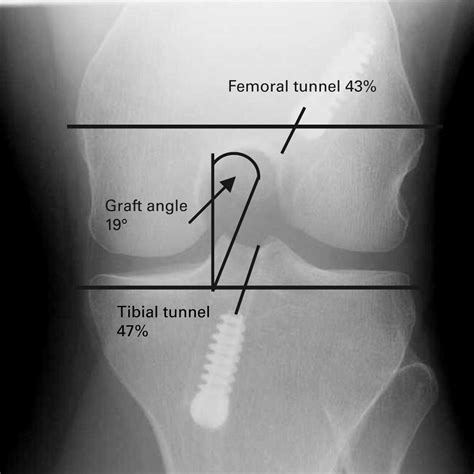 Radiological Landmarks For Placement Of The Tunnels In Single Bundle