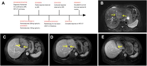 Frontiers Pd Blockade And Radiotherapy Combination For Advanced