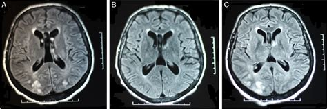 Leucoencefalopat A Posterior Reversible Un Caso Recurrente Y At Pico