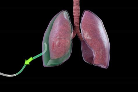 Pneumothorax