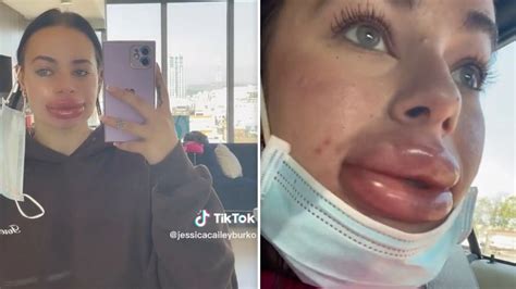 Influencer Gets Free Lip Filler Recounts Horror Story Of Botched Procedure In Viral Video